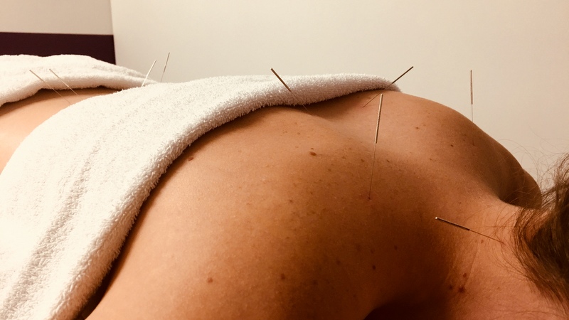 Acupuncture