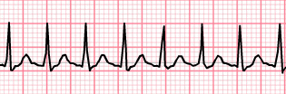 ECG