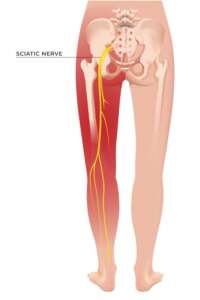 Sciatica